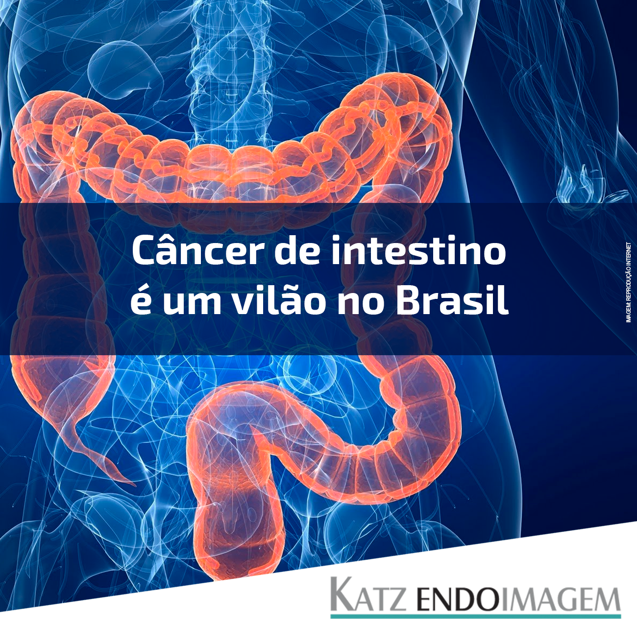 Tudo O Que Você Precisa Saber Sobre Câncer De Intestino – IIOMI